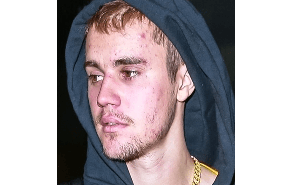 Justin Bieber Anuncia Que Tem Doen A De Lyme Foram Dois Anos Dif Ceis