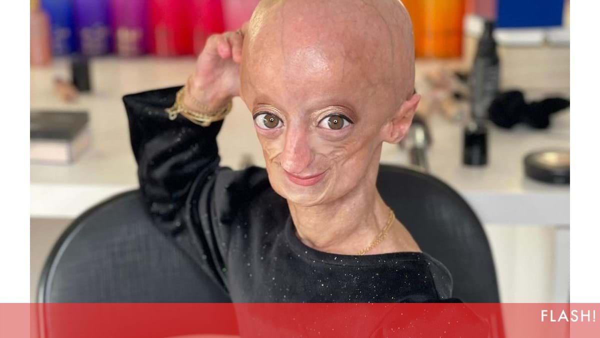 Cl Udia Amaral A Portuguesa Que Faleceu Aos Anos Devido Progeria