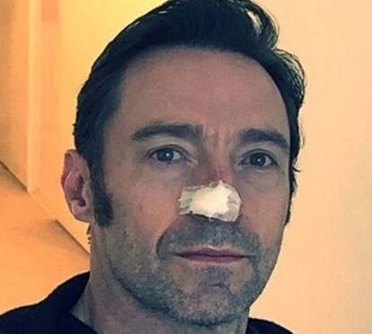 Hugh Jackman teve 6 tumores no nariz