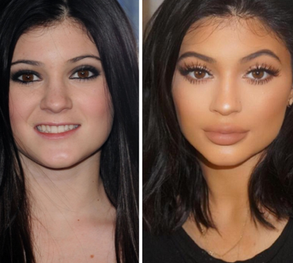 Com recurso a plásticas, Kylie Jenner transforma-se na irmã, Kim Kardashian