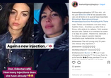georgina, botox, plásticas