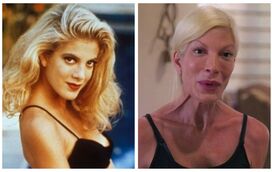 Tori Spelling, outra vítima de excessos da cirurgia plástica 