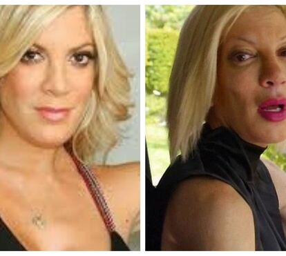 Tori Spelling, outra vítima de excessos da cirurgia plástica 