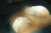 Silicone, Implante, Cirurgia plástica