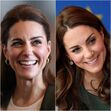 Kate Middleton, Botox