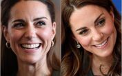 Kate Middleton, Botox