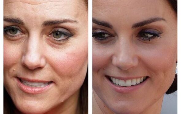Kate Middleton, Botox