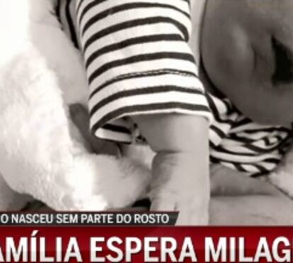 Milagre? Especialistas não conseguem explicar sobrevivência de Rodrigo, o bebé sem rosto