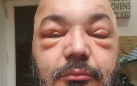 Desfigurado, Fernando Rocha faz ajuste de contas com o médico