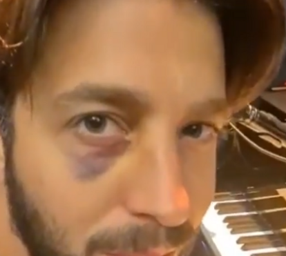 Salvador Sobral surge com olho negro no primeiro concerto do novo disco