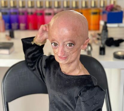 Cláudia Amaral, a portuguesa que faleceu aos 23 anos devido à progeria, doença que faz envelhecer o corpo 7 vezes mais depressa
