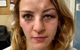 Campeã olímpica relata brutal agressão do companheiro e treinador e revolta-se contra Justiça