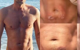 Cláudio Ramos colocou ferro a vapor contra barriga.... e ficou com uma brutal queimadura de 2.º grau e muitas dores