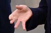 Kate Middleton, lesão, mão