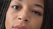 Jéssica Silva com lesão no olho