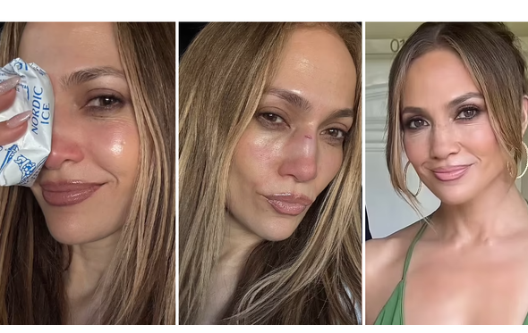 Jennifer Lopez mostra o antes e o depois do ferimento no nariz