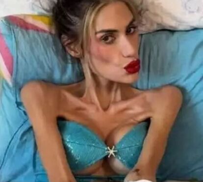Drama! Influencer morre com 22,5 quilos na ânsia de alcançar o 'corpo perfeito'