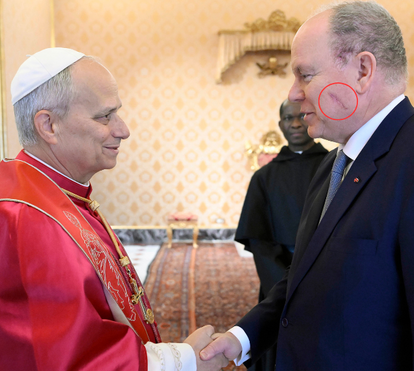 Príncipe Alberto aparece ao lado do Papa com grande cicatriz no rosto horas depois de o Palácio revelar cirurgia