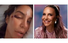 Hospitalizada e com cortes na cara! Ivete Sangalo cai em casa às 7 da manhã
