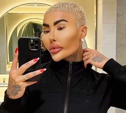 Tudo sobre Jordan James Parke, o 'Rei dos Lábios' que pagou 130 mil euros para ficar igual a Kim Kardashian e foi encontrado morto em Londres