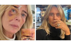 Uma cicatriz imensa no rosto por causa de uma pequena mancha na pele! Felipa Garnel conta tudo