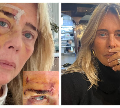 Uma cicatriz imensa no rosto por causa de uma pequena mancha na pele! Felipa Garnel conta tudo